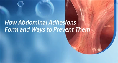 Kif Jiffurmaw Adeżjonijiet Addominali u Modi kif Tevitahom