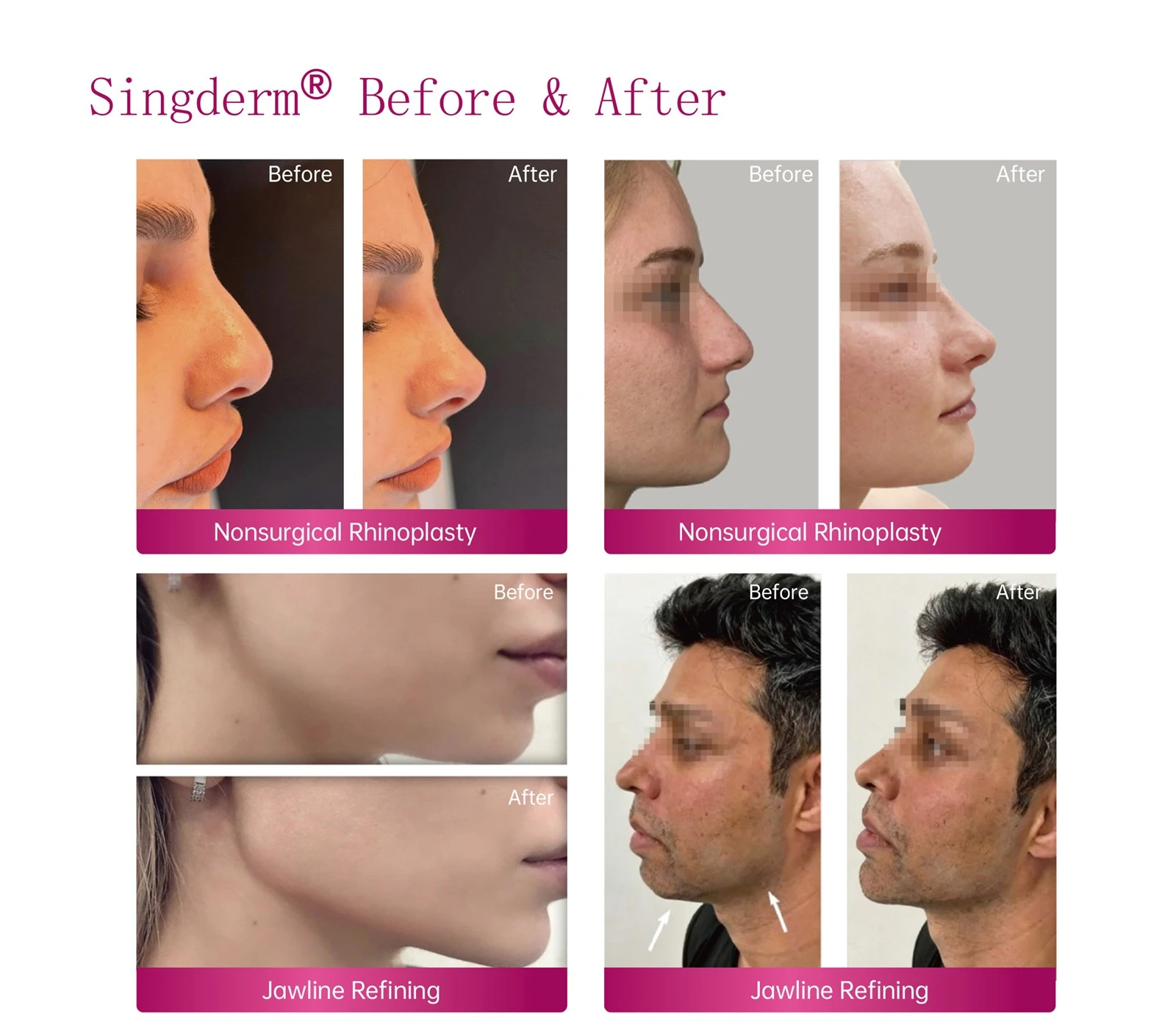 long-lasting-hyaluronic-acid-dermal-filler long-lasting-hyaluronic-acid-dermal-filler